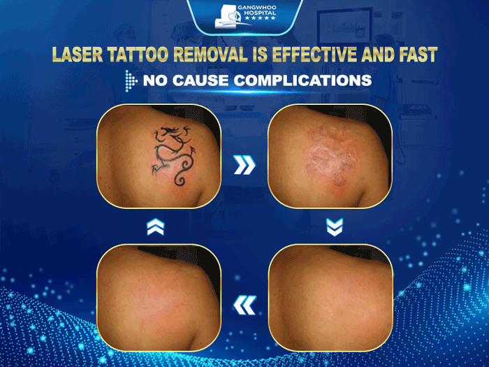 Tattoo Removal With Laser
