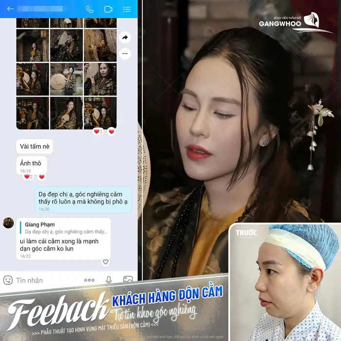 Feedback khách hàng chia sẻ sau độn cằm tại BVTM Gangwhoo giờ đã tự tin khoe góc nghiêng thon đẹp 