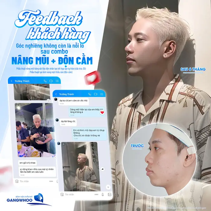 Feedback của khách hàng khoe góc nghiêng đẹp cuốn hút sau phẫu thuật độn cằm tại BVTM Gangwhoo