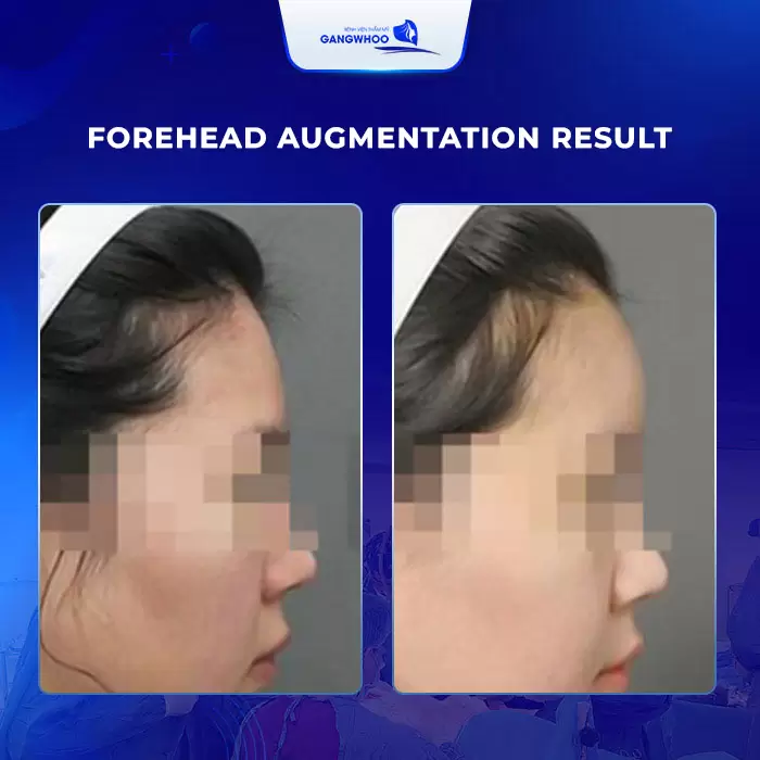 Forehead Augmentation - For A Natural and Elegant Face 3 filler 10