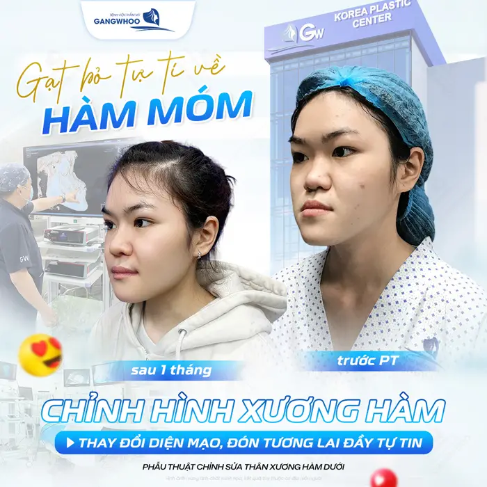 Gạt bỏ sử tự ti về hàm móm sau 1 tháng chỉnh sửa diện mạo đã hoàn toàn thăng hạng và khác biệt thấy rõ