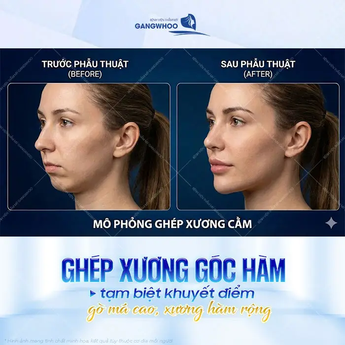 Ghép xương góc hàm tạm biệt khuyết điểm gò má cao và xương hàm rộng hiệu quả, an toàn và ít xâm lấn