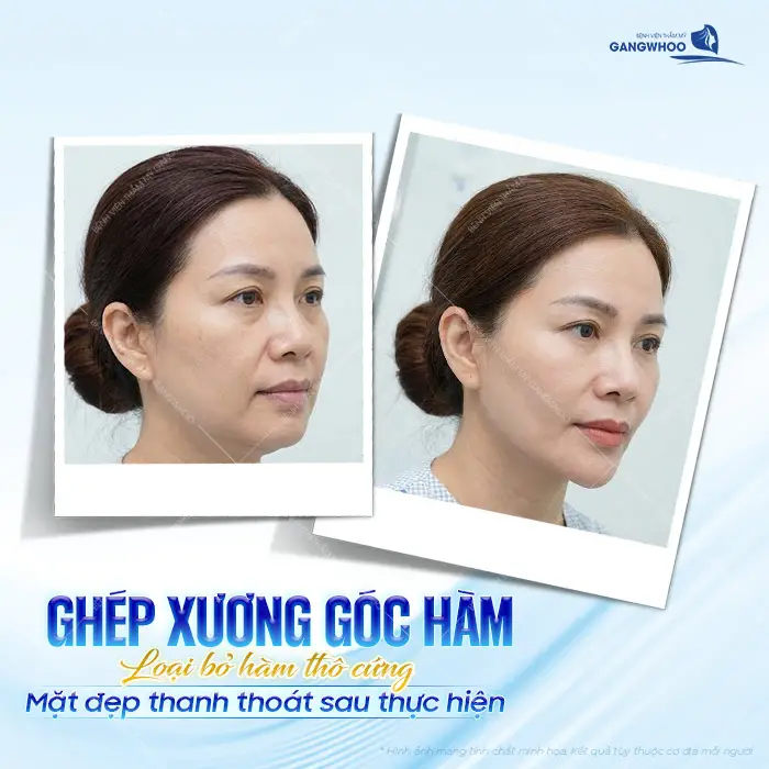Ghép xương góc hàm loại bỏ hàm thô cứng mặt đẹp thanh thoát ngay sau khi thực hiện đã hài hòa thấy rõ