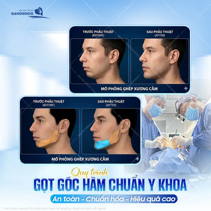 Quy trình gọt góc hàm chuẩn y khoa an toàn, chuẩn hóa và hiệu quả cao