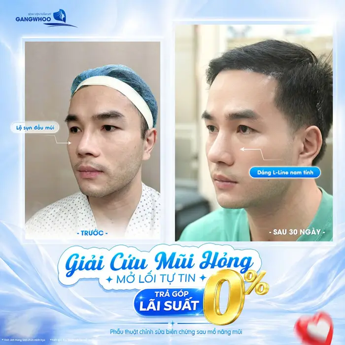 Tháo Chất Liệu Mũi "KHÔNG ĐAU, NHẸ NHÀNG, THOẢI MÁI" 2 Giải cứu mũi hỏng mở lối tự tin trả góp linh hoạt không lo áp lực chi phí