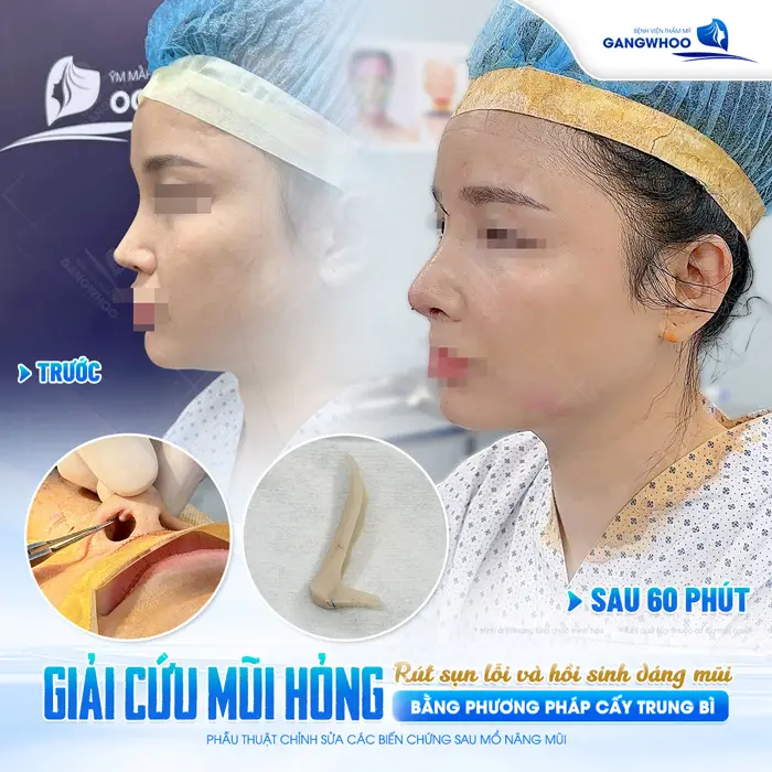 Giải cứu mũi hỏng hồi sinh dáng mũi chỉ sau 60 phút diện mạo đã hài hòa và cân đối trở lại 