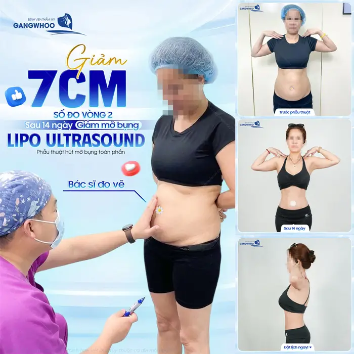 Giảm 7 cm số đo vòng 2 sau 14 ngày giảm mỡ bụng công nghệ Lipo Ultrasound hiện đại