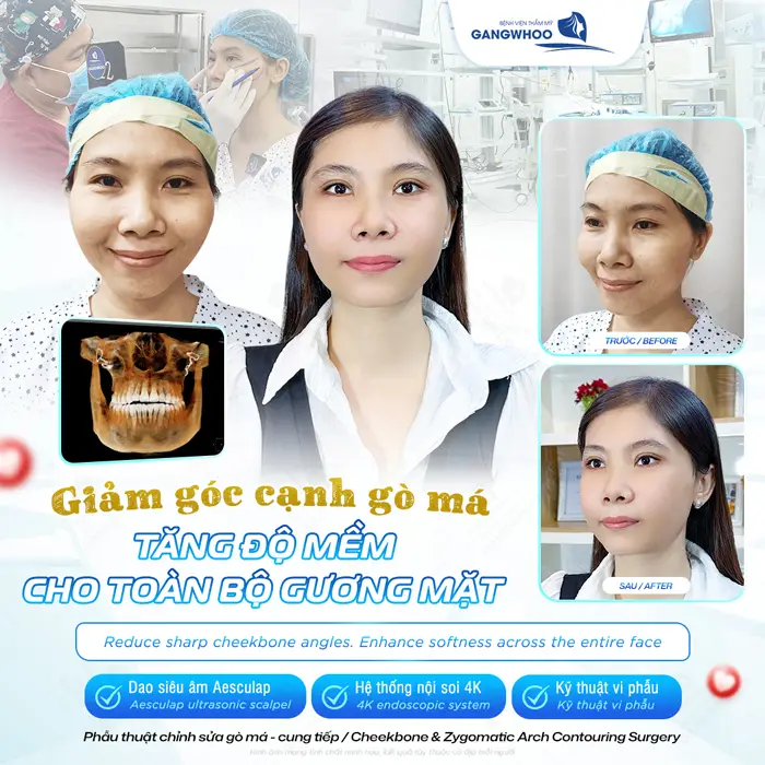 Giảm góc cạnh hạ gò má tăng ođò mềm cho toàn bộ gương mặt thêm hài hòa, ấn tượng và hấp dẫn 