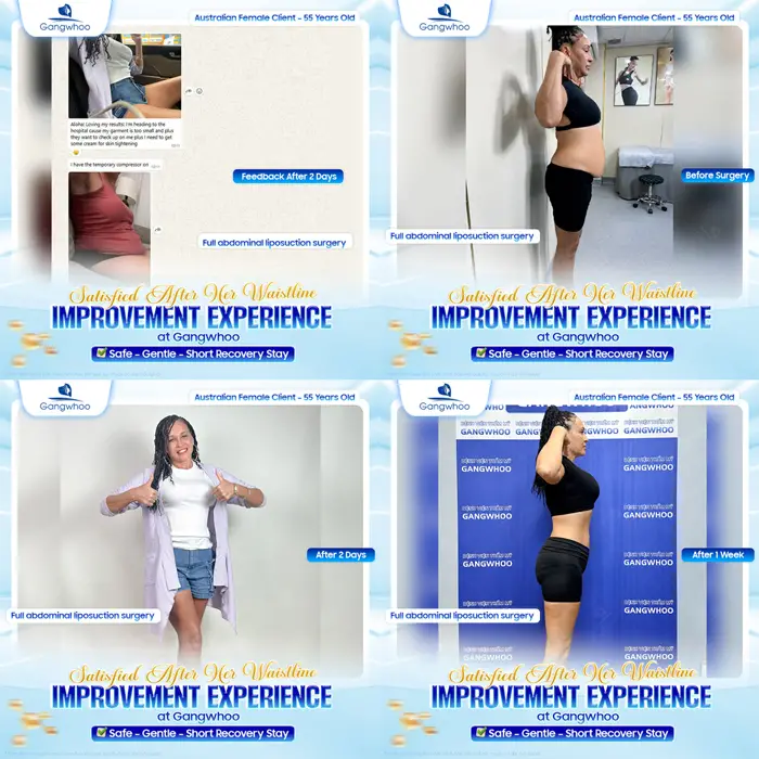 Abdominal Liposuction (Abdominal 3D Lipo) - Tiny Waist is No Longer A Dream 5 giam mo bung 3d lipo 3