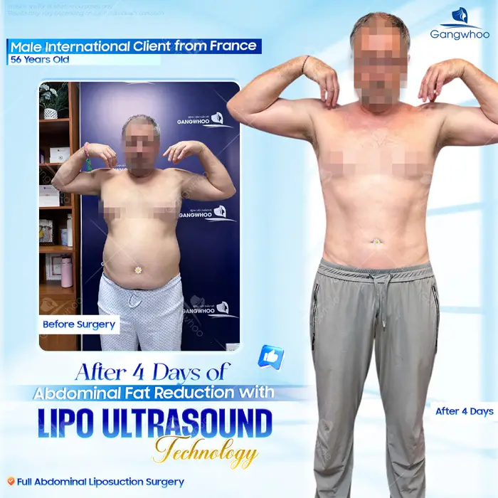 Abdominal Liposuction (Abdominal 3D Lipo) - Tiny Waist is No Longer A Dream 6 giam mo bung 3d lipo 5
