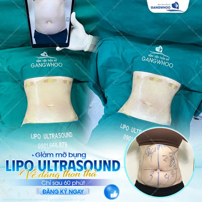 Giảm mỡ bụng công nghệ (Lipo Ultrasound) chỉ sau 60 phút eo thon nuột nà, vóc dáng chuẩn đẹp 