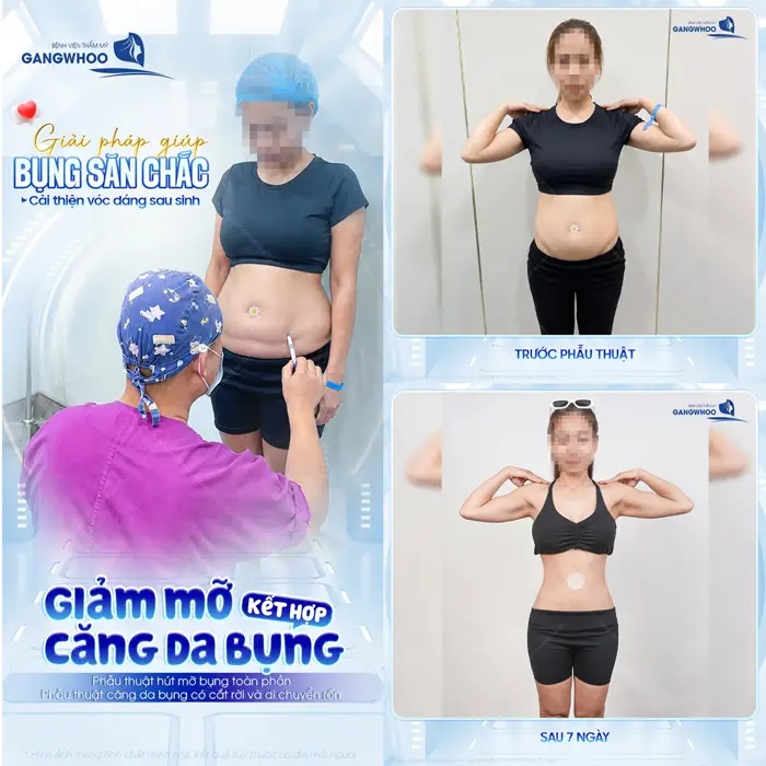 Giải pháp bụng săn chắc cải thiện vóc dáng sau sinh giảm mỡ kết hợp căng da bụng