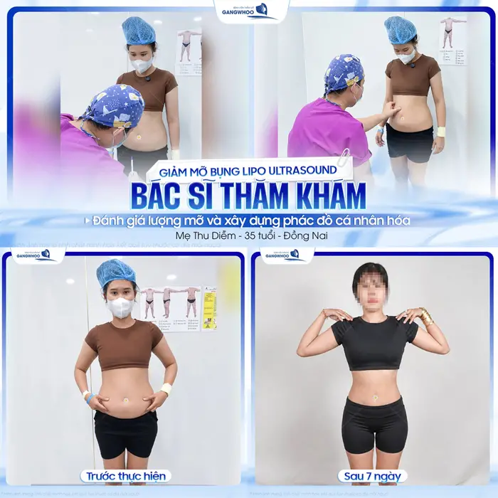 Giảm mỡ bụng Lipo Ultrasound bác sĩ thăm khám đánh giá lượng mỡ và xây dựng phác đồ cá nhân chuẩn hóa