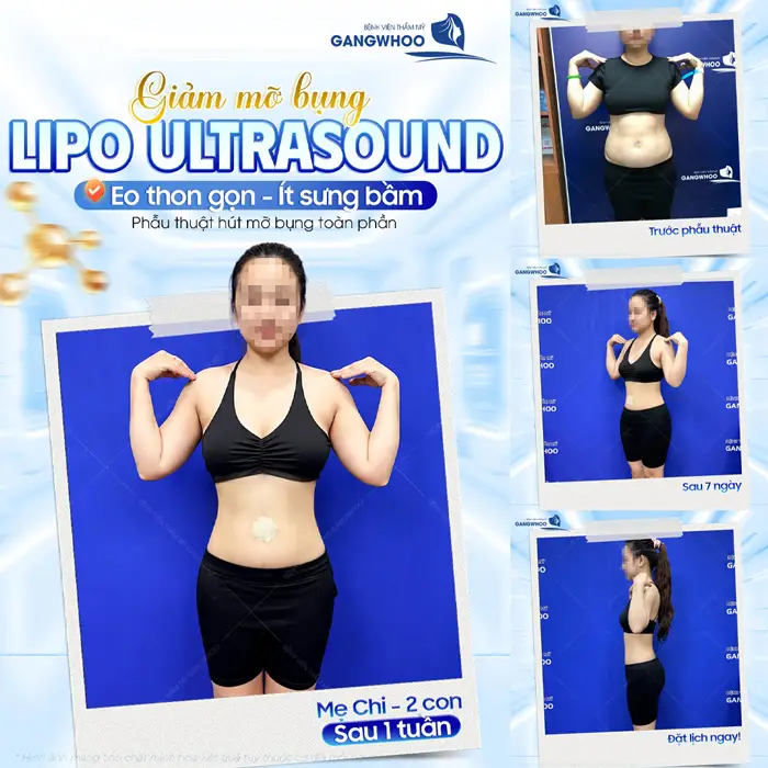 Giảm mỡ bụng Lipo Ultrasound eo thon gọn và ít sưng bầm sau 1 tháng đã thon đẹp xuất sắc
