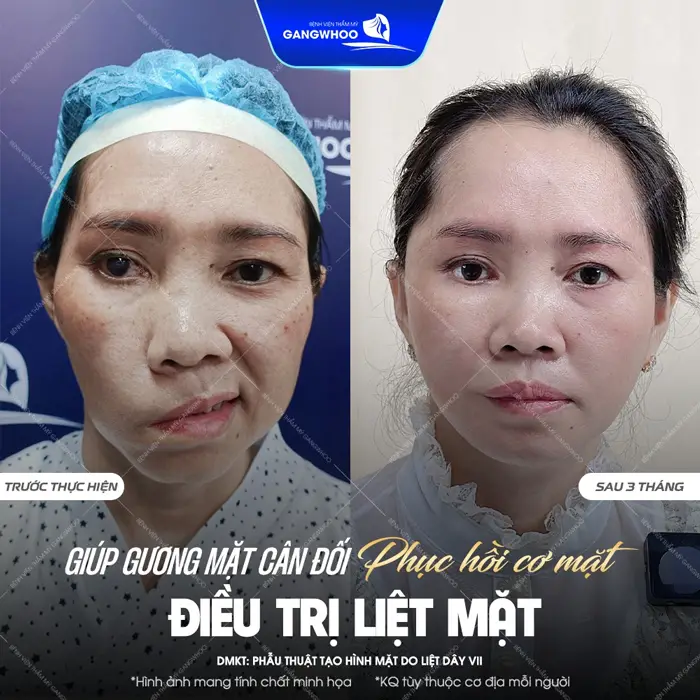 Giúp gương mặt cân đối hồi phục điều trị liệt mặt sau 3 tháng mặt đã cân đối và hài hòa
