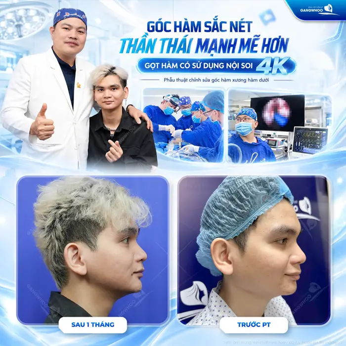 Góc hàm sắc nét thần thái mạnh mẽ hơn sau gọt hàm có sử dụng nội soi 4K
