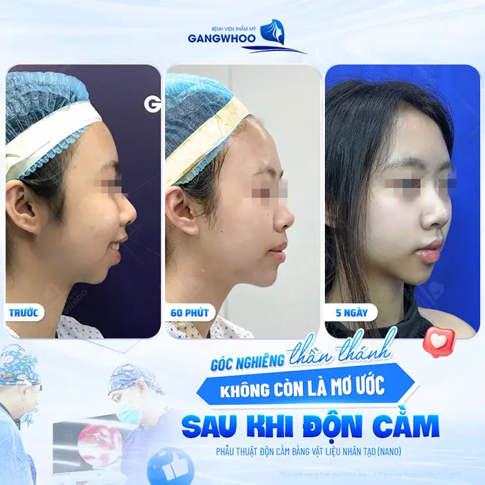 Góc nghiêng thần thái không còn là mơ ước sau khi độn cằm bằng vật liệud độn nhân tạo tại BVTM Gangwhoo