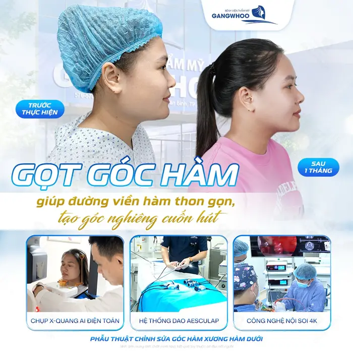 Gọt góc hàm giúp đường viền hàm thon gọn tạo góc nghiêng đẹp cuốn hút ánh nhìn 
