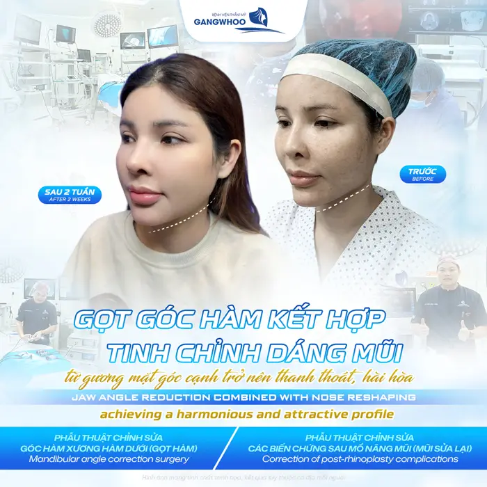 Gọt góc hàm kết hợp tinh chỉnh dáng mũi cằm đẹp thanh thoát, mềm mại và hài hòa hơn