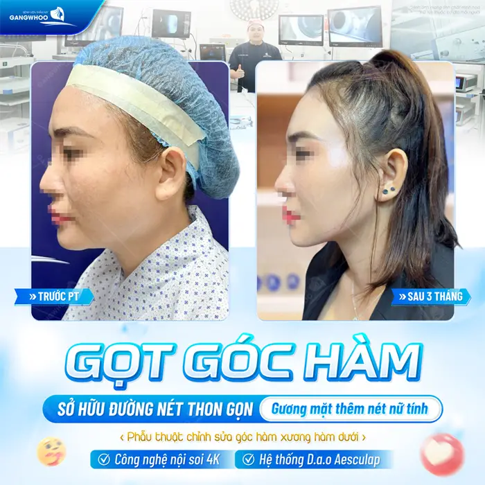 Gọt Góc Hàm, Cành Ngang, Góc Cằm Vuông Cho Mặt Thanh Tú 4 Gọt góc hàm sở hữu đường nét thon gọn gương mặt thêm nữ tính sau phẫu thuật chỉnh sửa góc hàm công nghệ cao