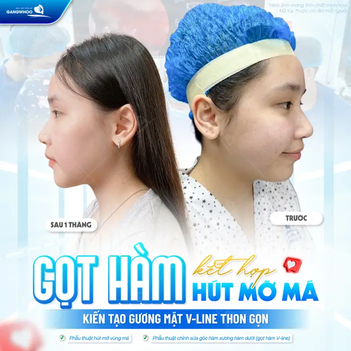 Gọt hàm kết hợp hút mỡ má kiến tạo đường mặt V Line đẹp thon gọn và mềm mại dài lâu 