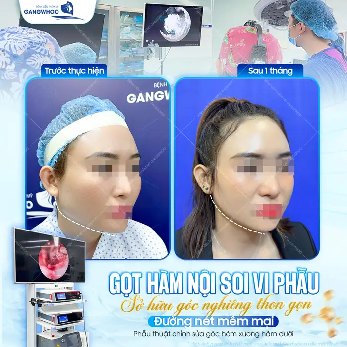 Gọt hàm nội soi vi phẫu sở hữu góc nghiêng thon gọn và đường nét mềm mại 