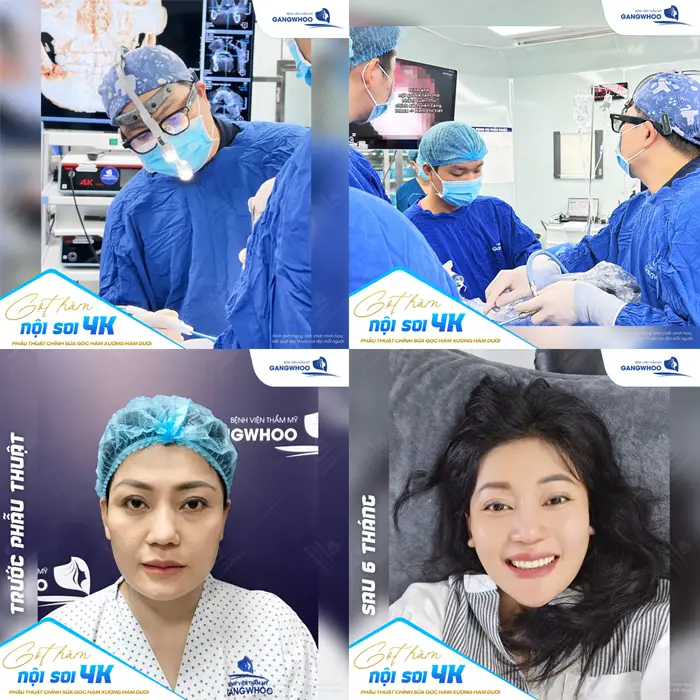 Gọt hàm nội soi 4K giải pháp cho khuôn mặt hài hòa, thon gọn và đẹp tự nhiên