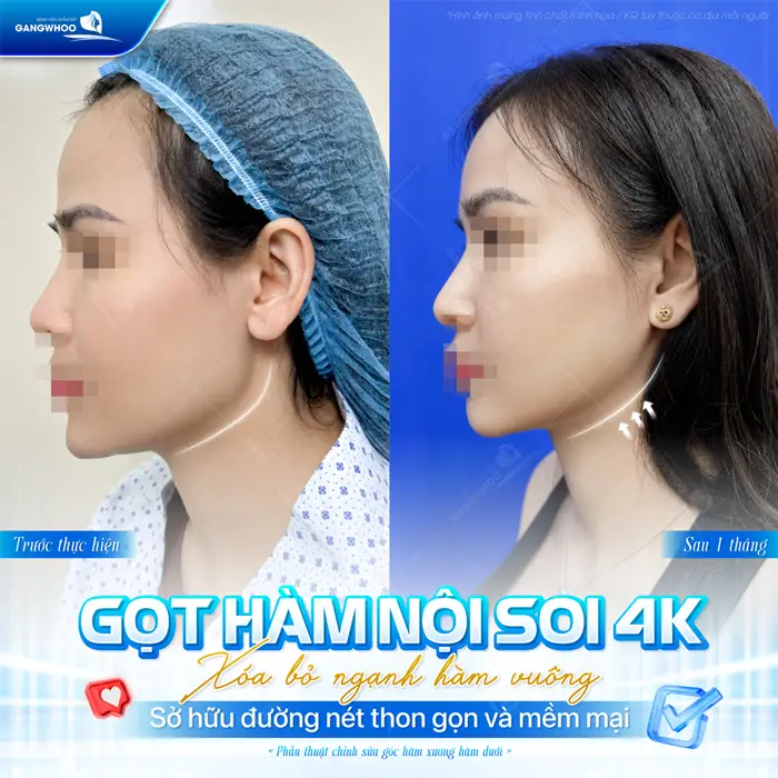 Gọt Góc Hàm, Cành Ngang, Góc Cằm Vuông Cho Mặt Thanh Tú 5 Gọt hàm nội soi 4K xóa bỏ ngạnh hàm vuông sở hữu đường nét thon gọn và mềm mại