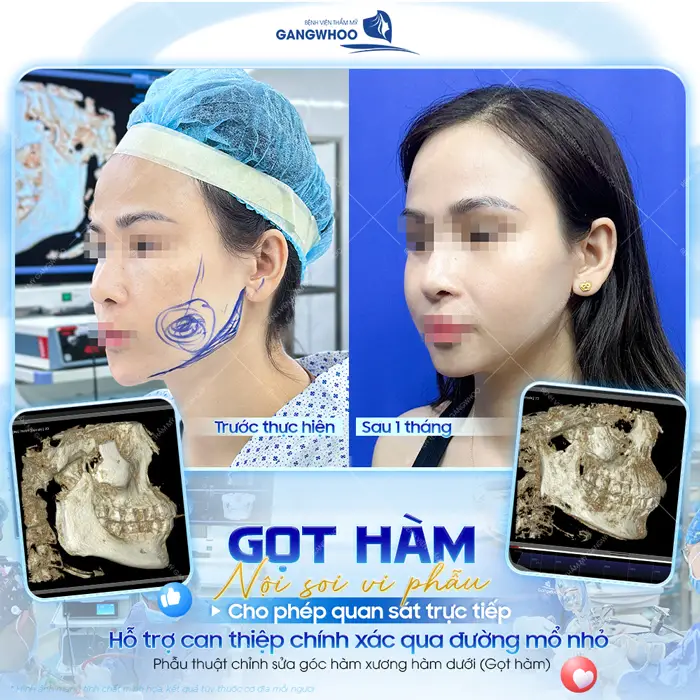 Gọt hàm nội soi vi phẫu cho phép quan sát trực tiếp qua đường mổ nhỏ, giải pháp căn chỉnh góc hàm thon đẹp mềm mại