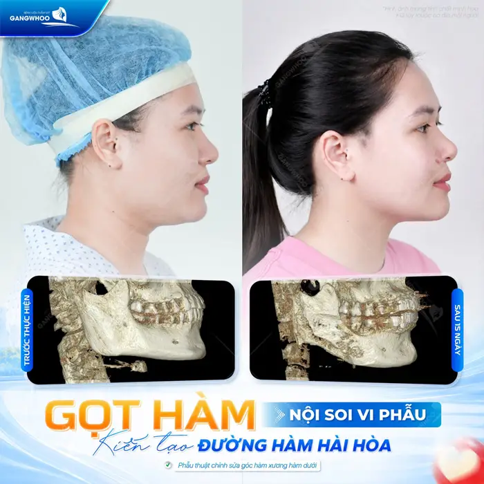 Gọt Hàm Và Điều Chỉnh Trục Xương Giúp Gương Mặt Thon Gọn 5 Gọt hàm nội soi vi phẫu kiến tạo đường hàm hài hòa, gương mặt thêm thăng hạng và đầy thanh thoát