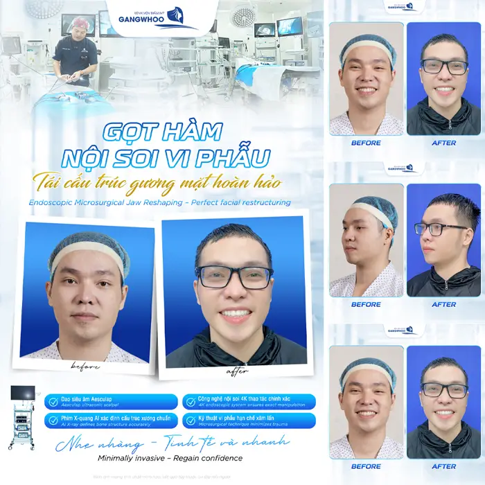 Tái cấu trúc gương mặt với kỹ thuật gọt hàm nội soi vi phẫu đường nét đẹp hoàn hảo hơn, rạng rỡ hơn