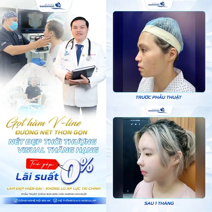 Gọt hàm V Line đường nét thon gọn với visual cuốn hút với lãi suất 0% tại bệnh viện thẩm mỹ Gangwhoo 