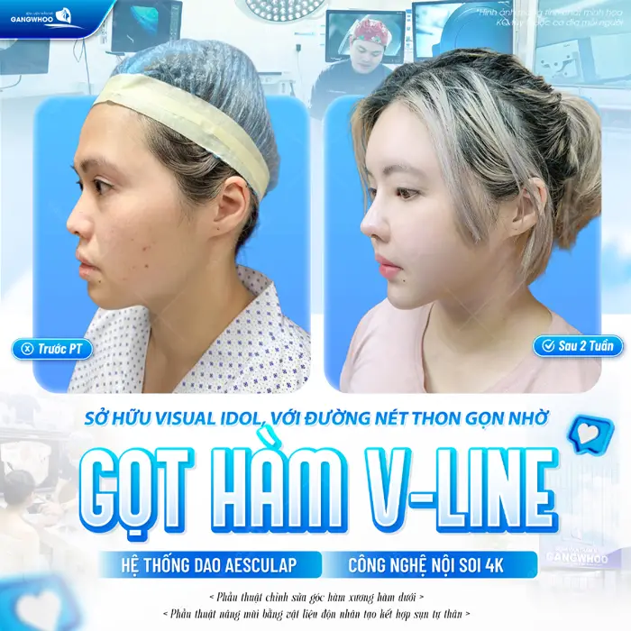 Sở hữu đường nét thon gọn với kết quả gọt hàm V Line đẹp hoàn hảo sau 2 tuần thực hiện nhan sắc thăng hạng thấy rõ