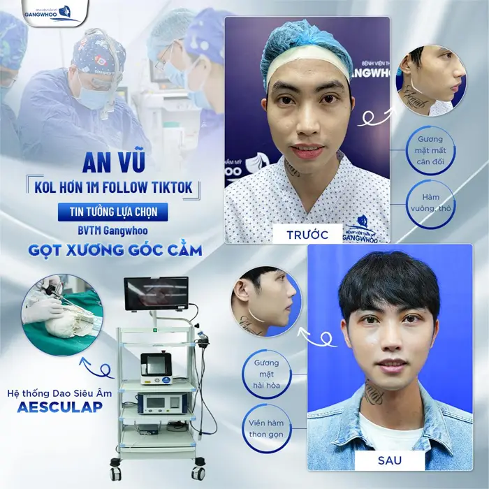 Khách hàng sau khi can thiệp gọt xương góc cằm