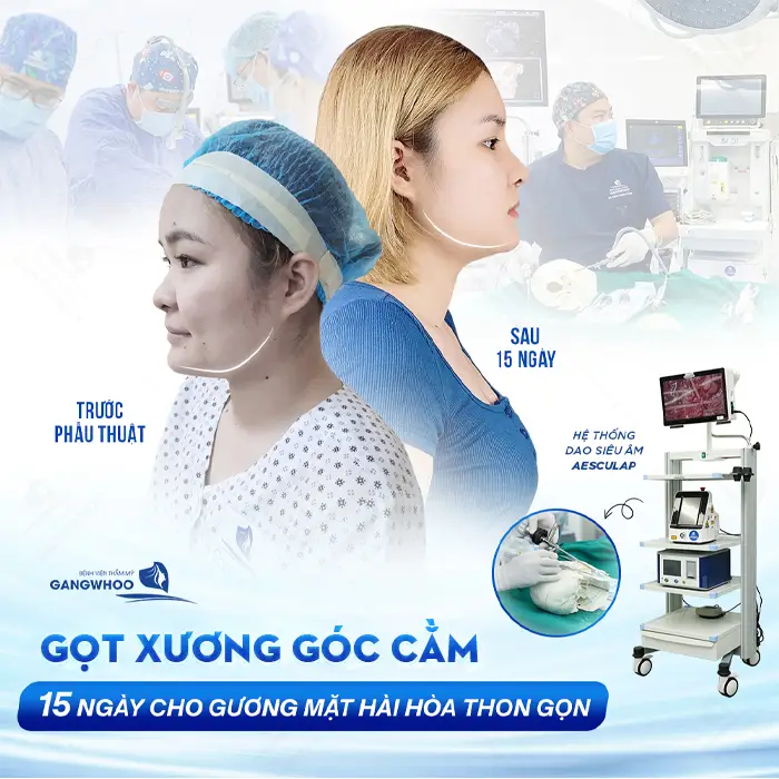 Ưu Điểm Gọt Xương Góc Cằm