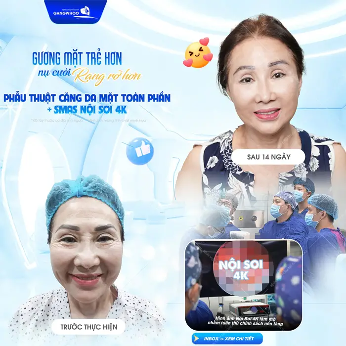 Gương mặt trẻ hơn sau phẫu thuật căng da mặt toàn phần Smas nội soi 4K