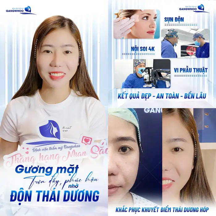 Pengisi Dahi untuk Wajah Ramping Penuh Vitalitas 3 Gương mặt tròn đầy phúc hậu nhờ độn thái dương với kết quả đẹp bền lâu