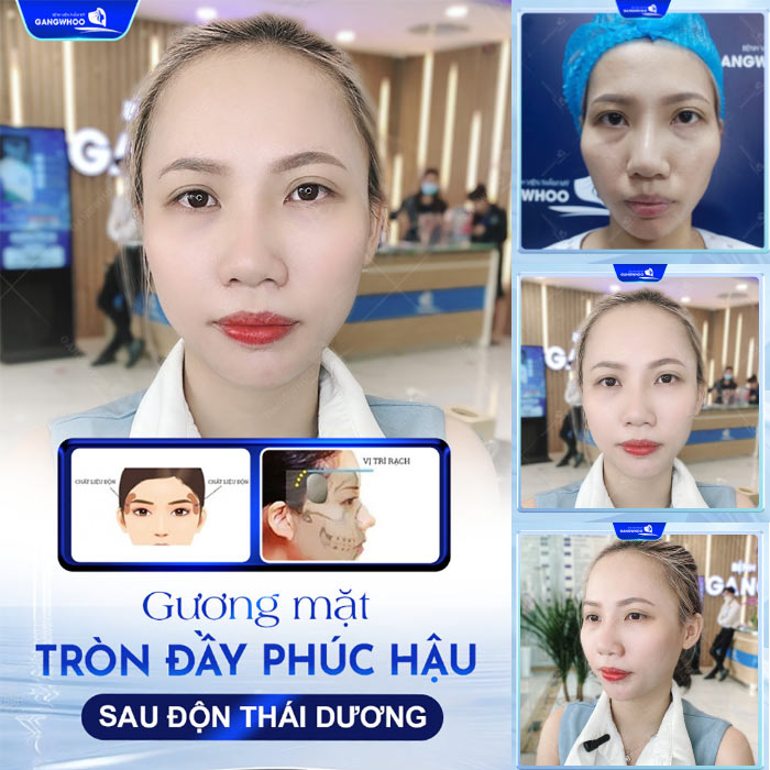Độn Thái Dương Sở Hữu Gương Mặt Thanh Tú Đầy Sức Sống 23 Khách hàng hài lòng với diện mạo mới sau khi độn thái dương tại Gangwhoo