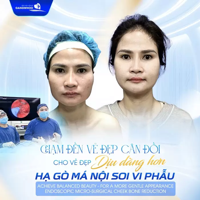 Phẫu Thuật Hạ Gò Má Cao Vi Phẫu Là Gì? Quy Trình Và Chi Phí 2 Hạ gò má nội soi vi phẫu chạm đến vẻ đẹp cân đối cho diện mạo đẹp dịu dàng hơn