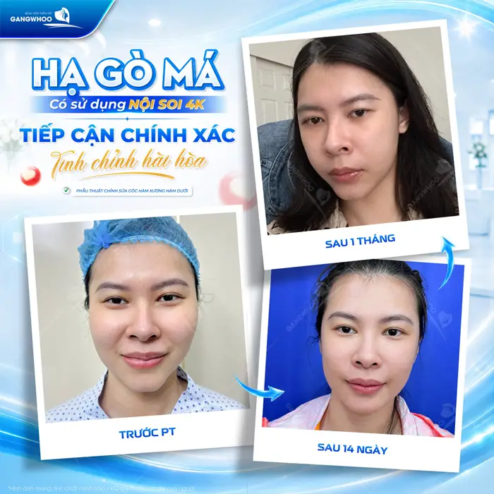 Hạ gò má có sử dụng nội soi 4K tiếp cận chính xác giúp tinh chỉnh khuyết điểm gò má thon gọn và mềm mại