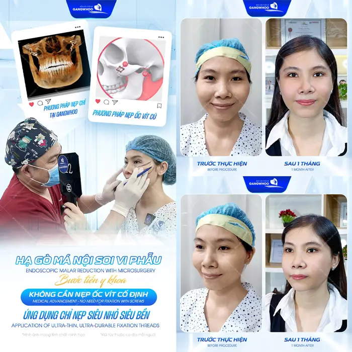 Hạ gò má nội soi vi phẫu với bước tiến chuẩn y khoa mặt đẹp hài hòa và mềm mại tự nhiên