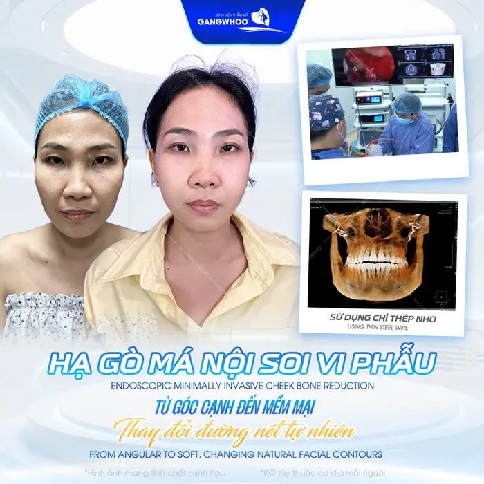 Hạ gò má nội soi 4K từ góc cạnh đến mềm mại thay đổi đường nét đầy tự nhiên