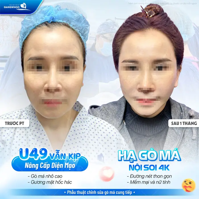 Hạ gò má nội soi đường nét khuôn mặt đẹp thanh thoát, mềm mại và nữ tính U49 vẫn kịp nâng cấp diện mạo