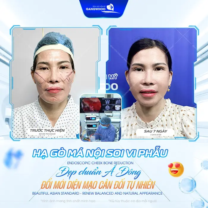 Hạ gò má nội soi vi phẫu diện mạo đẹp chuẩn Đông Á cân đối và đầy tự nhiên