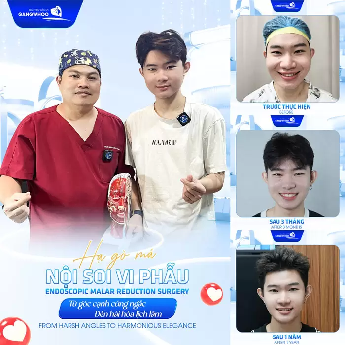 Phẫu Thuật Hạ Gò Má Cao Vi Phẫu Là Gì? Quy Trình Và Chi Phí 6 Hạ gò má nội soi từ gương mặt góc cạnh đến hài hòa thanh thoát