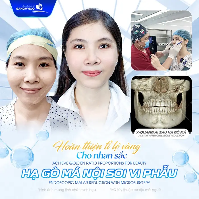 Phẫu Thuật Hạ Gò Má Cao Vi Phẫu Là Gì? Quy Trình Và Chi Phí 5 Hạ ogf má nội soi hoàn thiện gương mặt đẹp chuẩn cho nhan sắc đẹp thăng hạng
