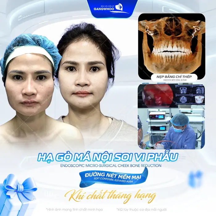 Hạ gò má nội soi ci phẫu đường nét mềm mại khí chất thăng hạng tự tin