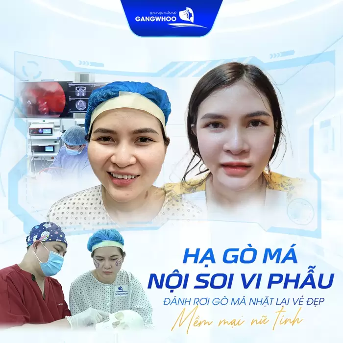Phẫu Thuật Hạ Gò Má Cao Vi Phẫu Là Gì? Quy Trình Và Chi Phí 7 Hạ gò má nội soi vi phẫu sở hữu gương mặt hài hòa, thanh thoát nâng tầm vẻ đẹp mềm mại, nữ tính