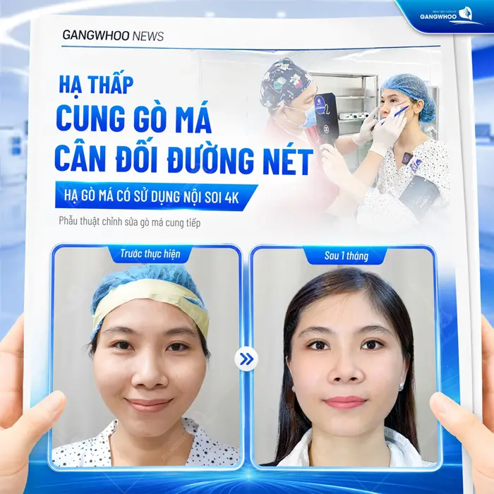 Hạ thấp cung gò má cân đối đường nét sử dụng nội soi 4K