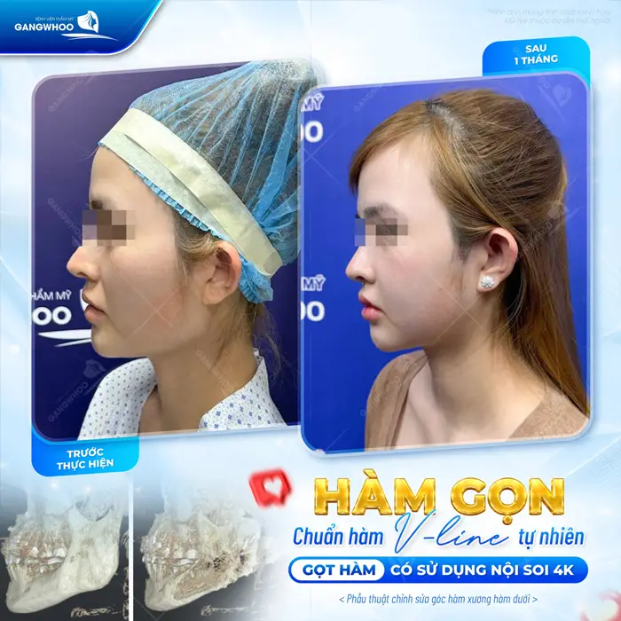 Hàm gọn chuẩn V Line đẹp tự nhiên chuẩn tỷ lệ gương mặt thêm cuốn hút và hài hòa 